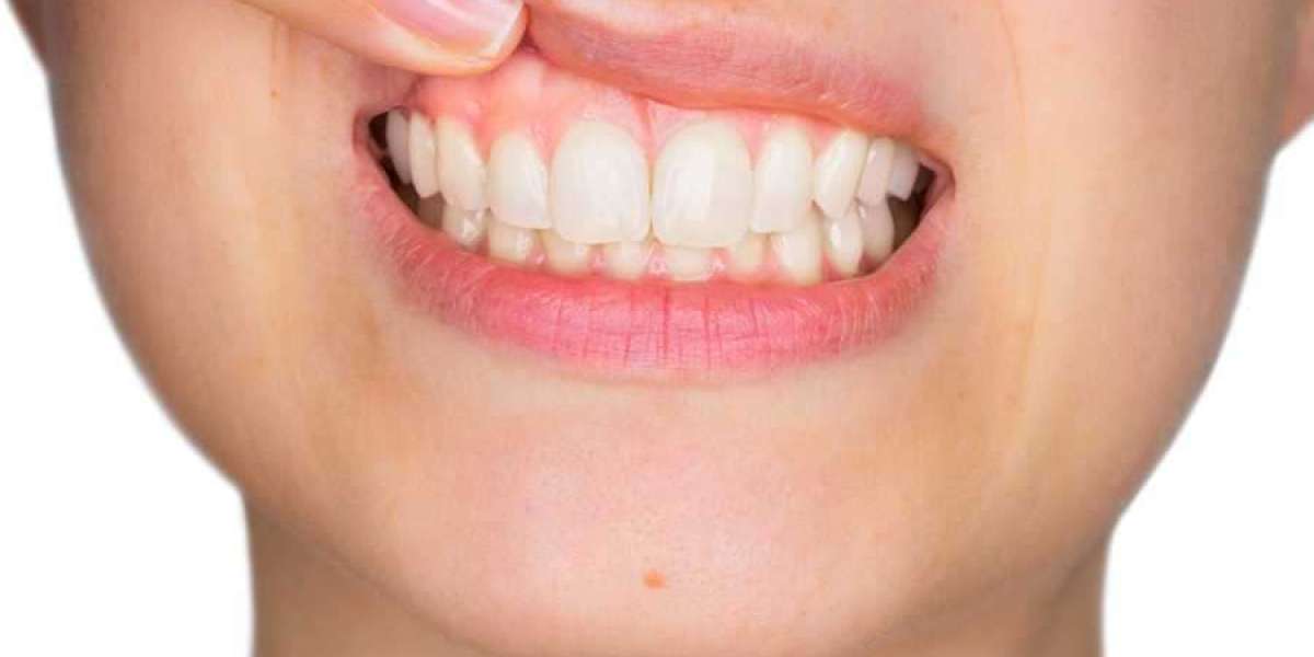 Common Misconceptions About Gum Recession and Dental Care