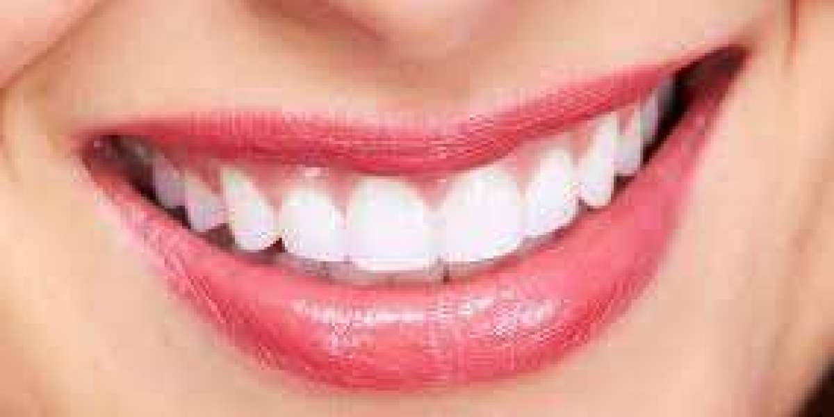 Top Teeth Whitening Services in Dubai