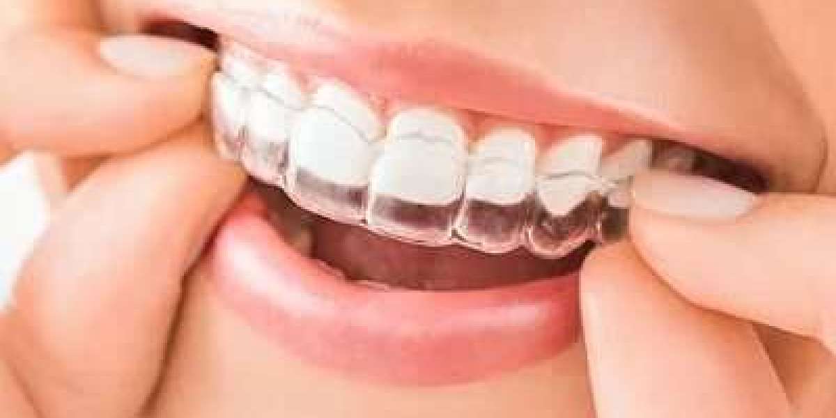 Clear Aligners for Teens: A Cool and Convenient Solution