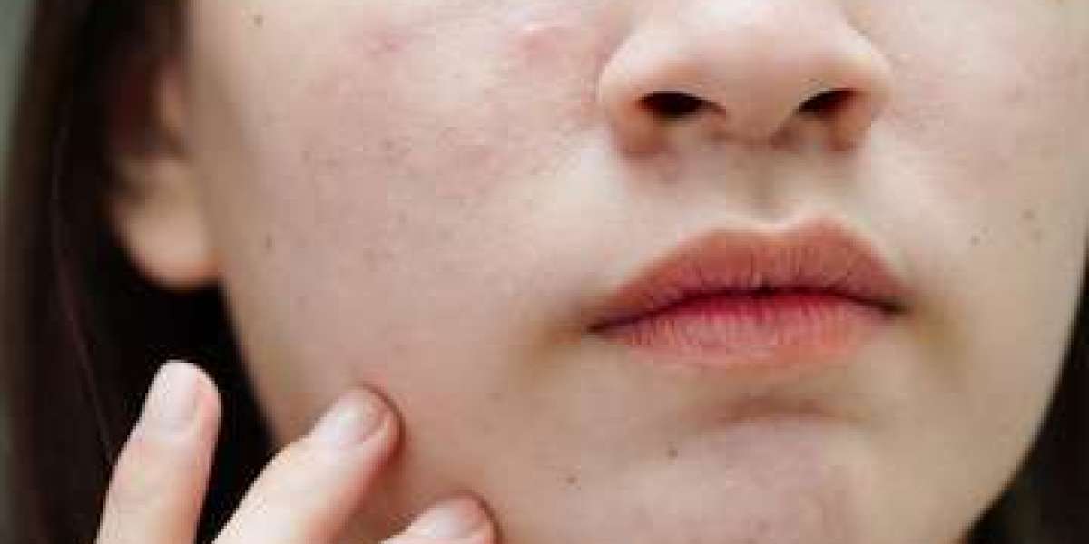 Skin Revival: Proven Pimple Remedies