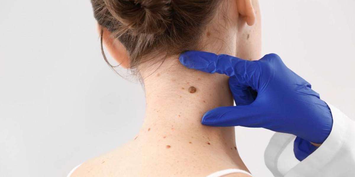Unmasking the Truth: Average Costs of Skin Tag Removal