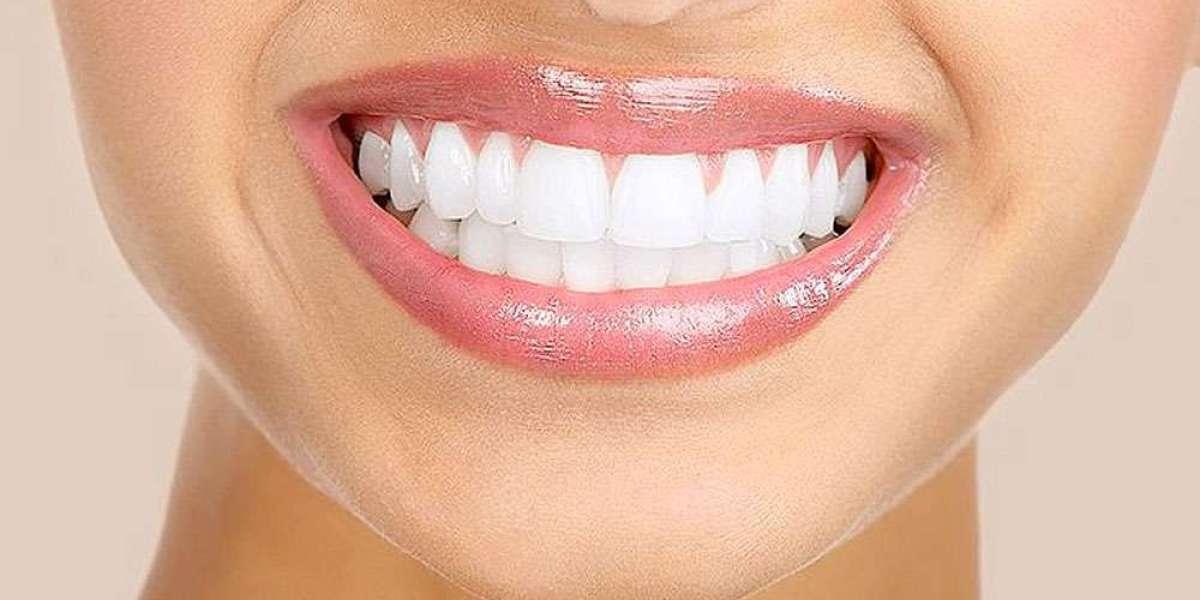 Achieve a Brighter Smile: Teeth Whitening Services in Dubai