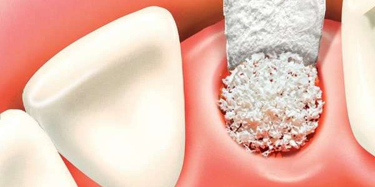 Dental Bone Graft Substitutes Market Outlook: growth, drivers and forecast report by 2032
