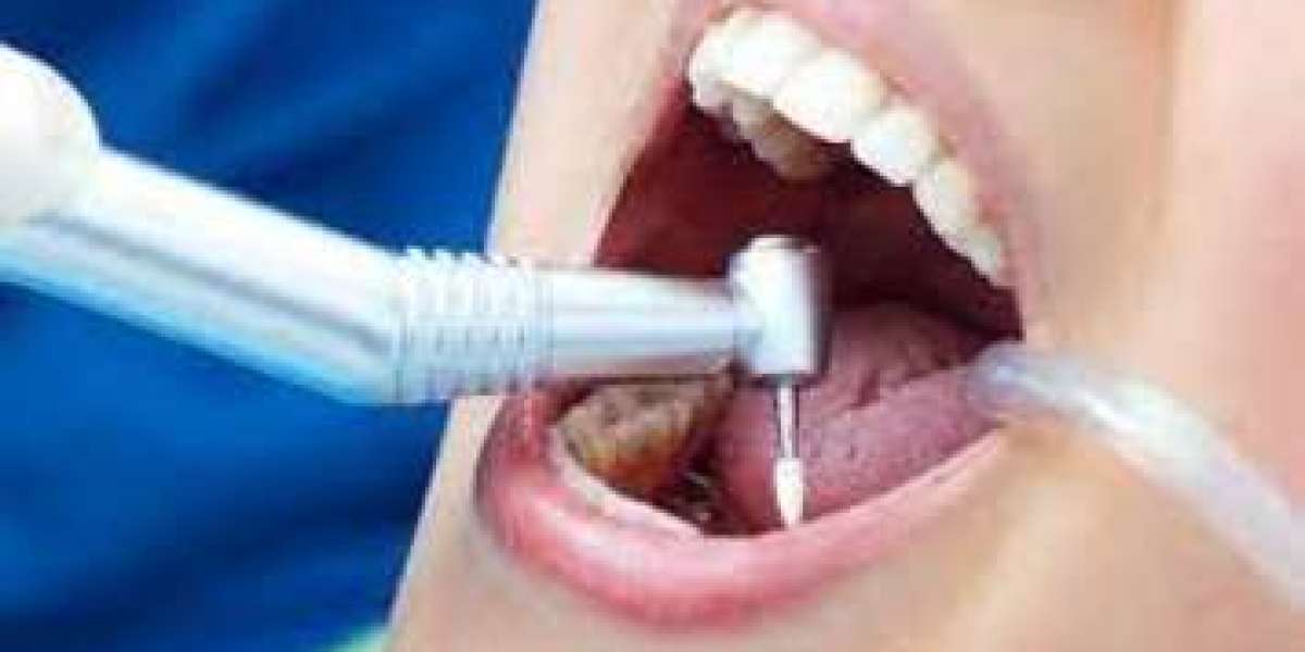 Root Canal Therapy for Healthy Smiles