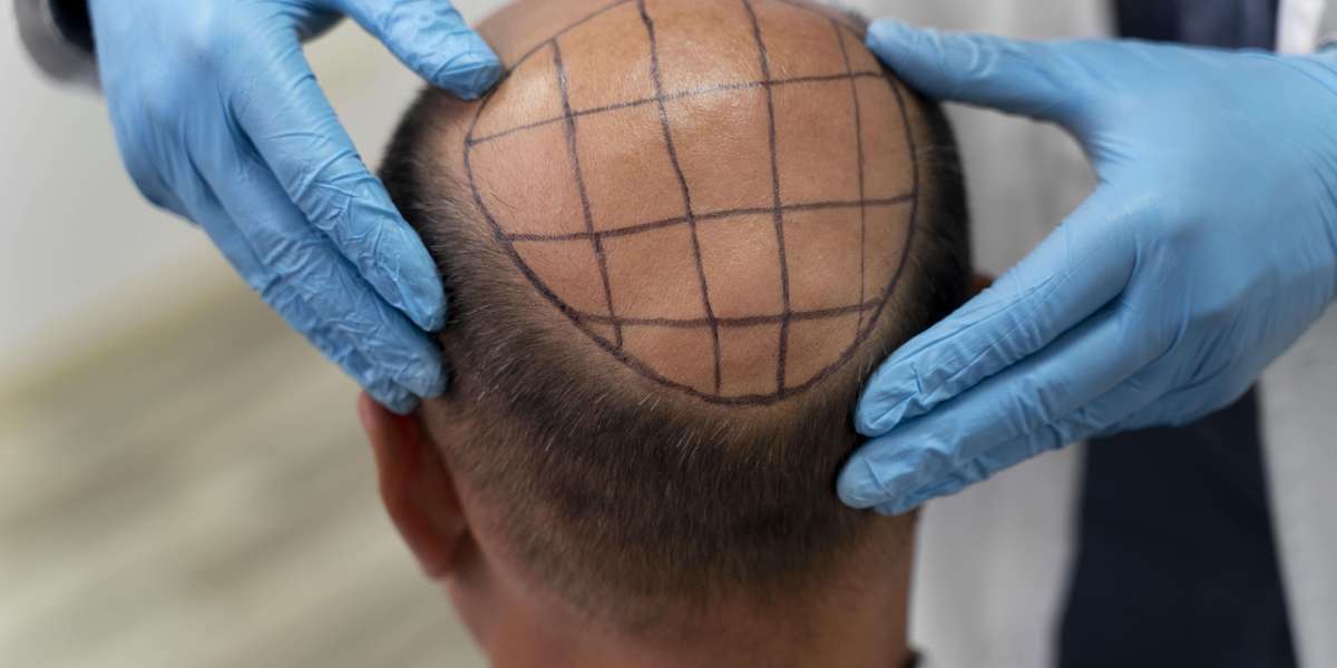 Is Hair Trnansplant treatment is used in Riyadh?