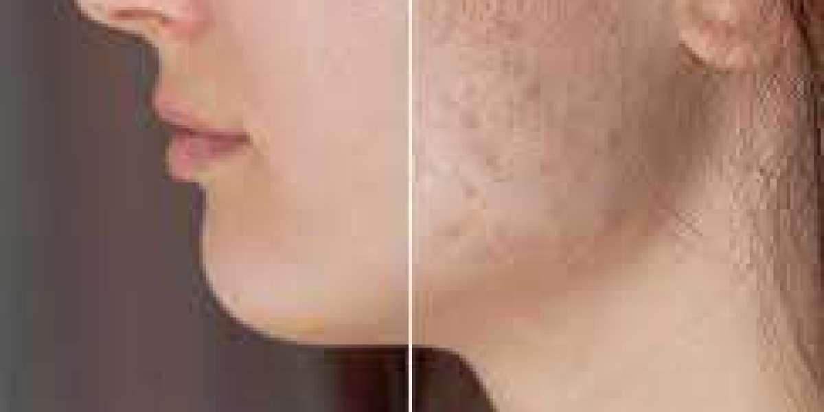 Laser Acne Scars Treatment in Sydney