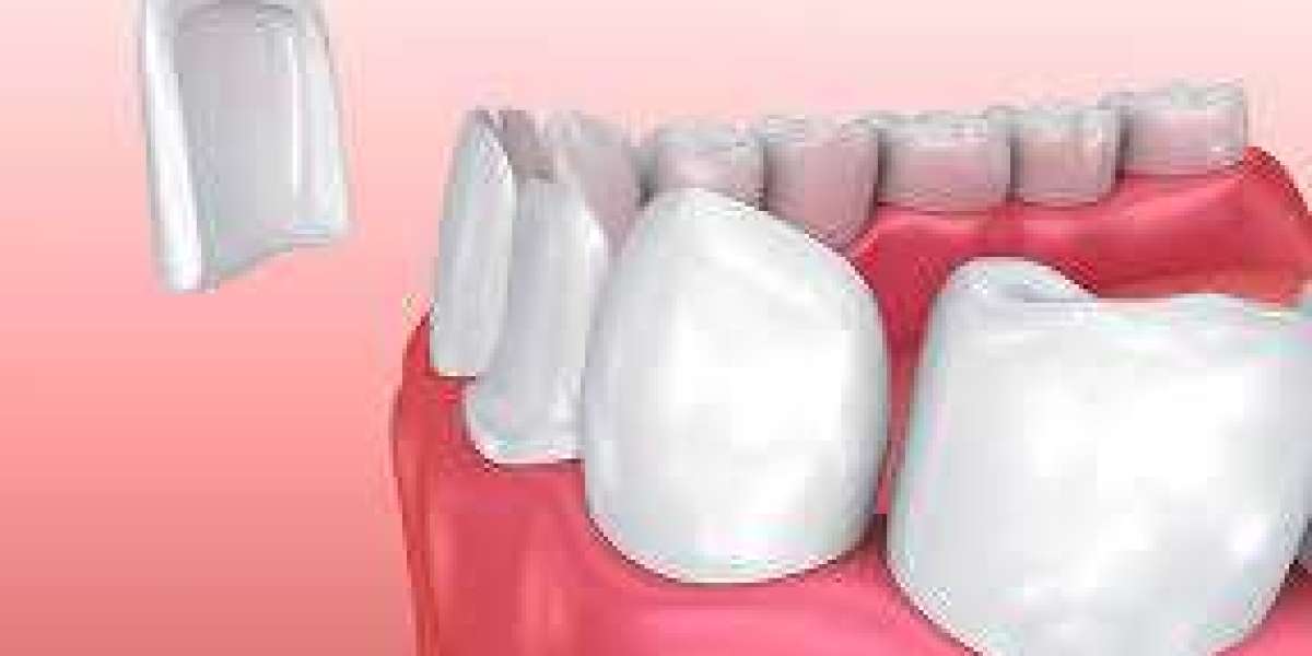 Smile Transformation: The Magic of Dental Veneers in Duba