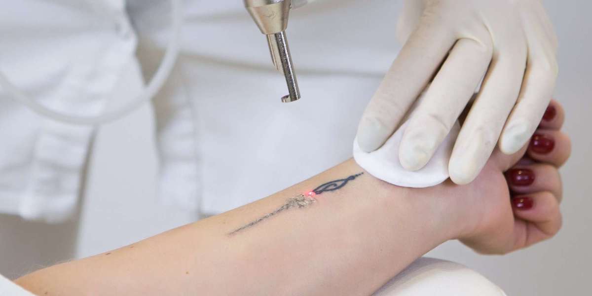 Is Laser Tattoo Removal Worth the Investment in 2023