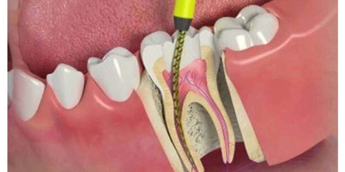 Dubai's Game-Changing Approach to Fear-Free Root Canals