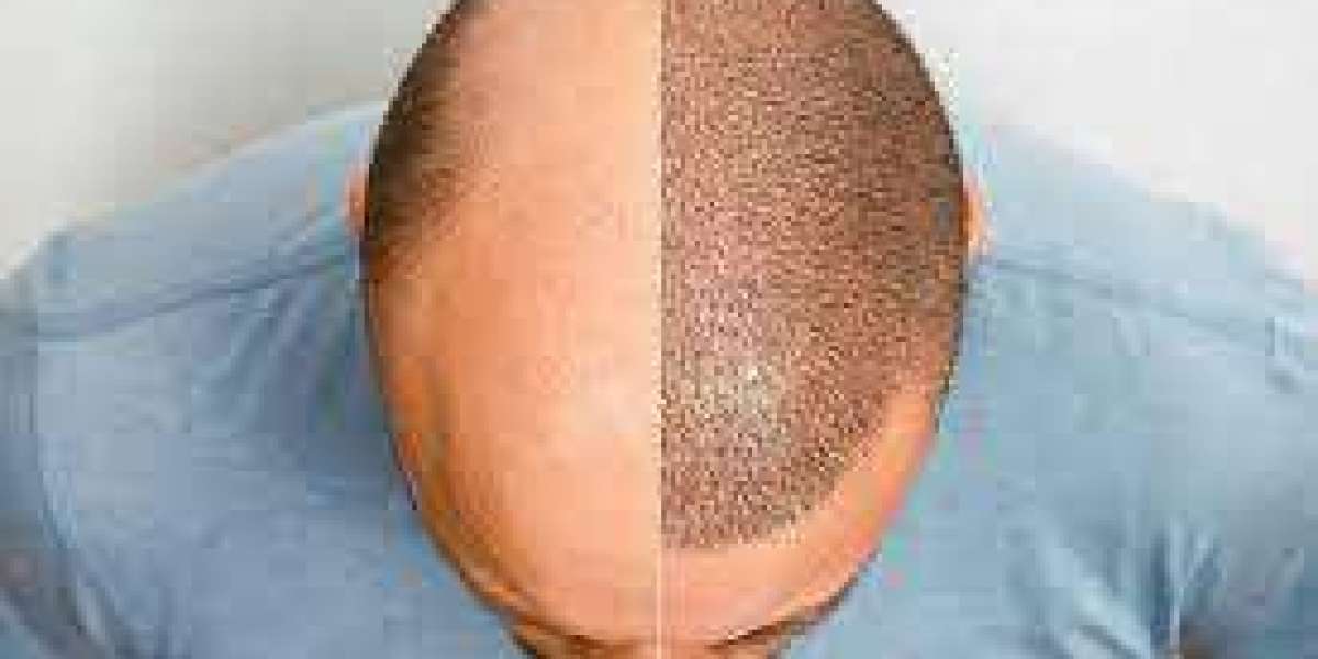 Follicular Frontier: Exploring the Latest in Hair Transplant Technology