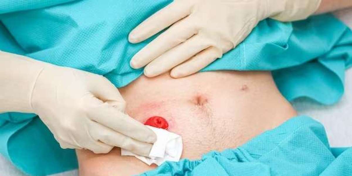 Global Stoma Care Market Size, Share, Share, Report Forecasts Forecasts 2022 - 2032