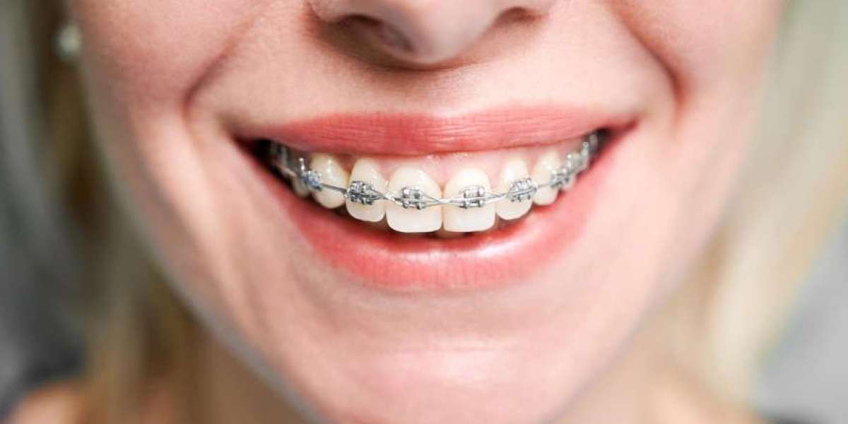 The Road to a Confident Smile: A Closer Look at Metal Braces