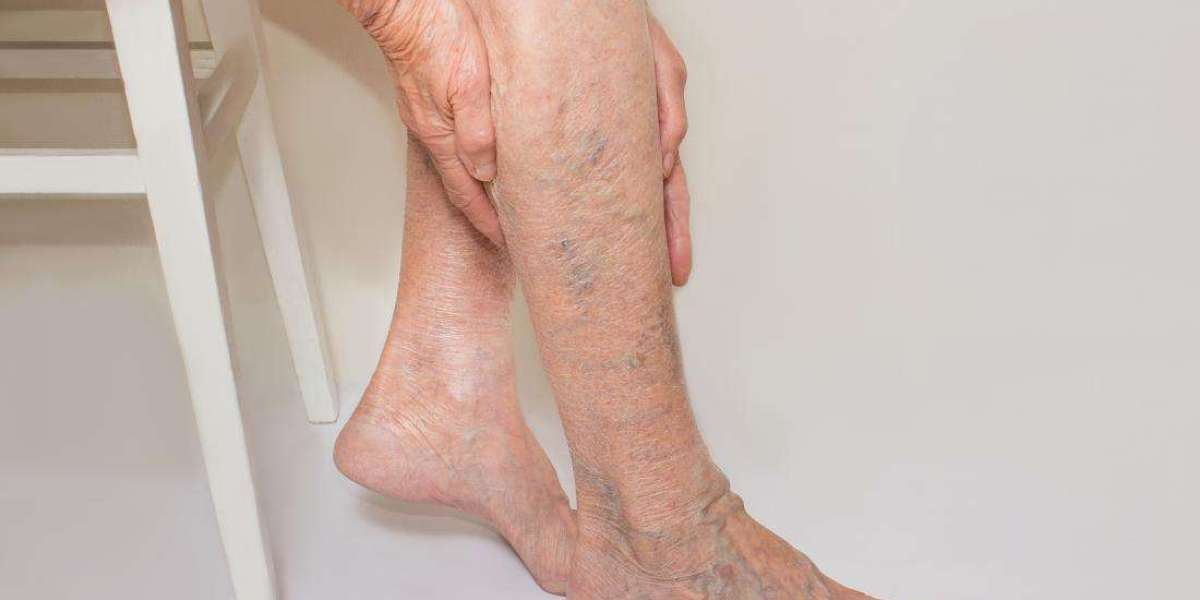 The Connection Between Varicose Veins and Venous Ulcers