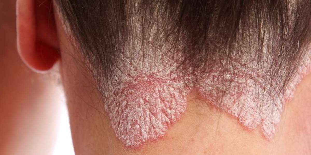 Eczema vs Psoriasis: Itchiness Variations