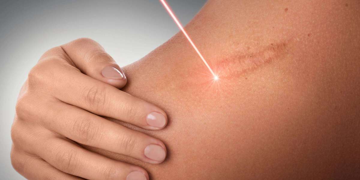 Laser Scar Removal: Rejuvenating Skin, Redefining Beauty