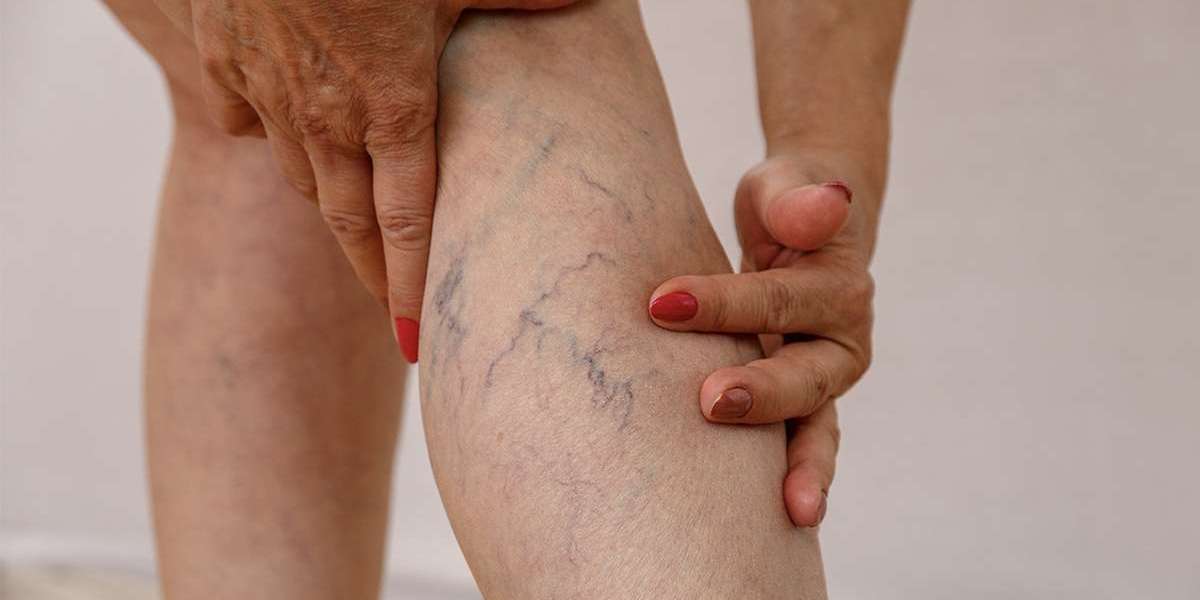 Legends of Liberation: Unveiling Effective Spider Veins Solutions