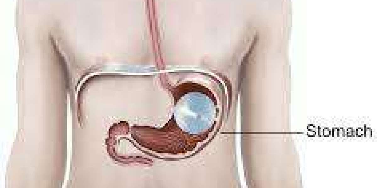 Dubai's Premier Gastric Balloon Clinic: Your Path to Sustainable Weight Loss