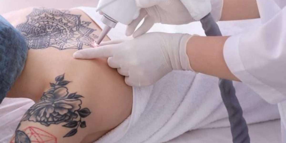 Your Ink's Nemesis: Best Laser Tattoo Removal in Dubai