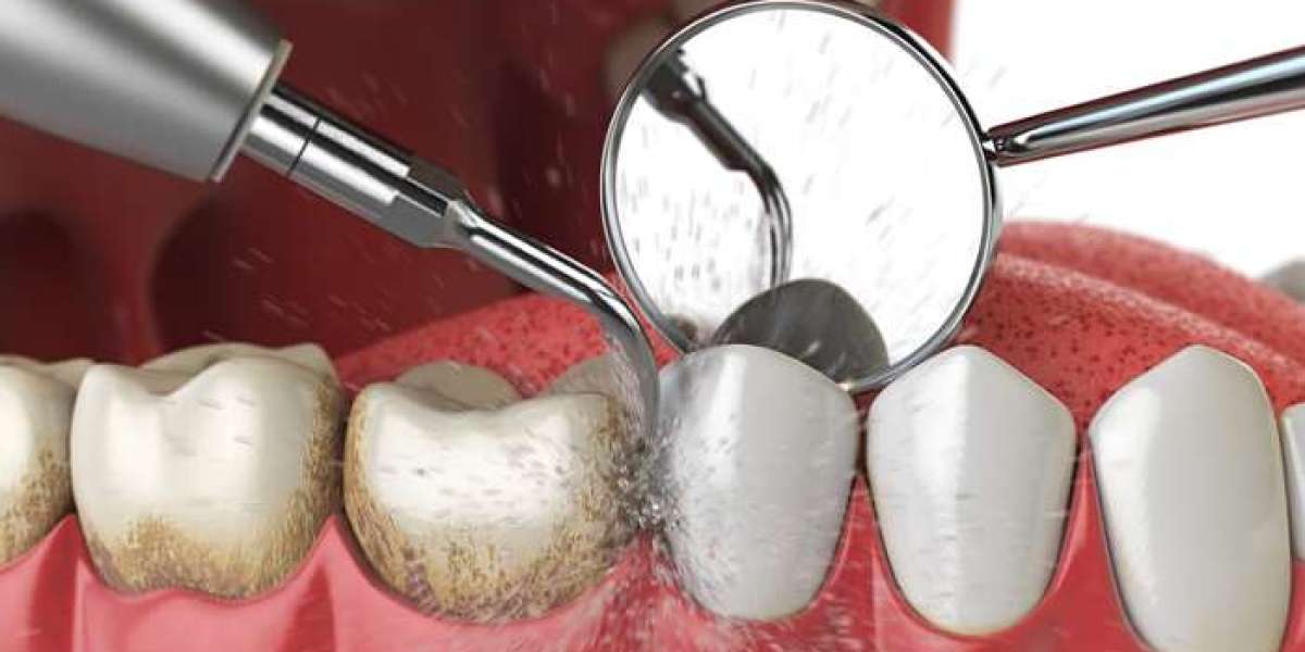 A Gleaming Smile Awaits: The Art of Dental Scaling