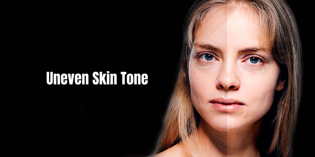 What Is Uneven Skin Tone? 5 Ways To Fix It?