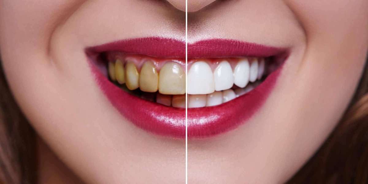 Snow-White Smiles: The Secrets of Effective Teeth Whitening