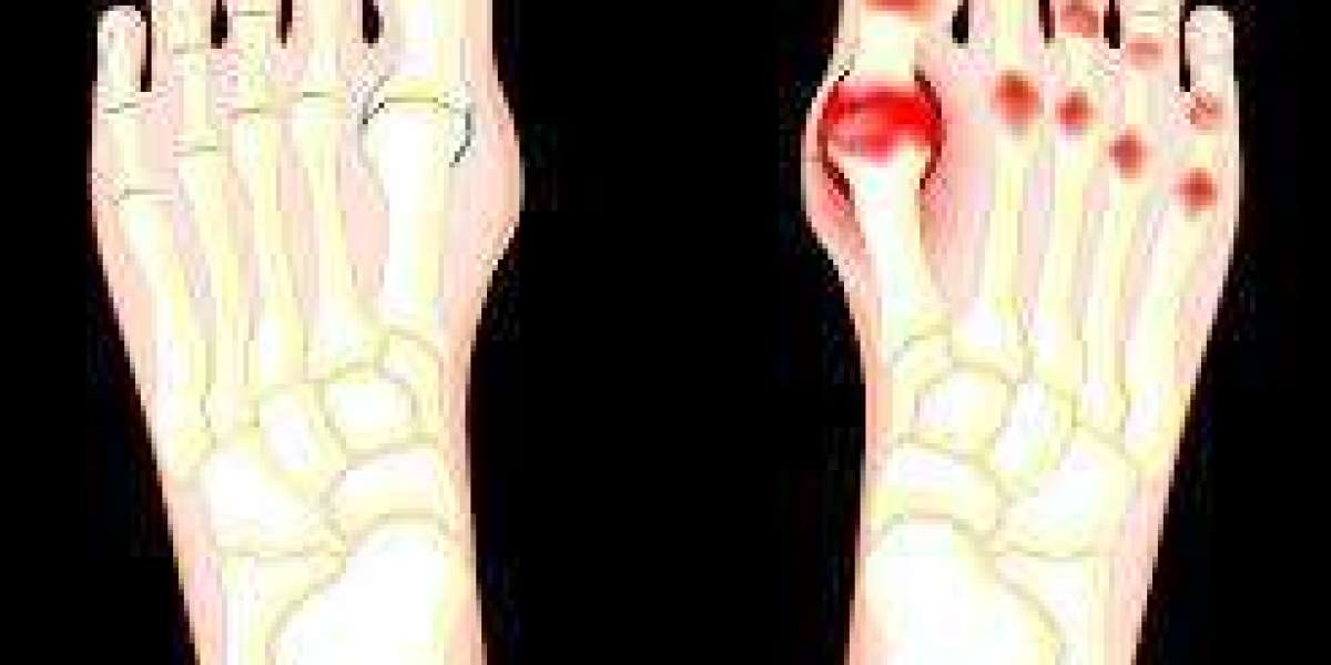 Understanding and Alleviating Toe Joint Pain: Causes, Symptoms, and Treatment Options