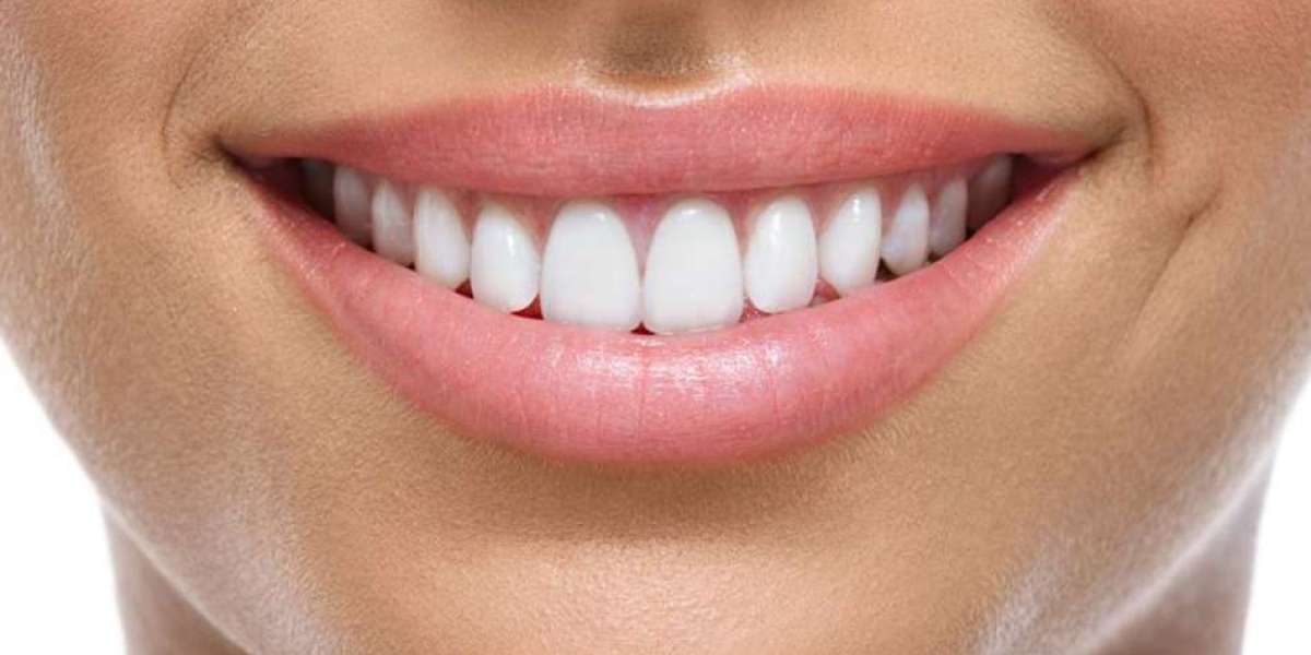 E-Max Veneers: Your Pathway to a Stunning Smile