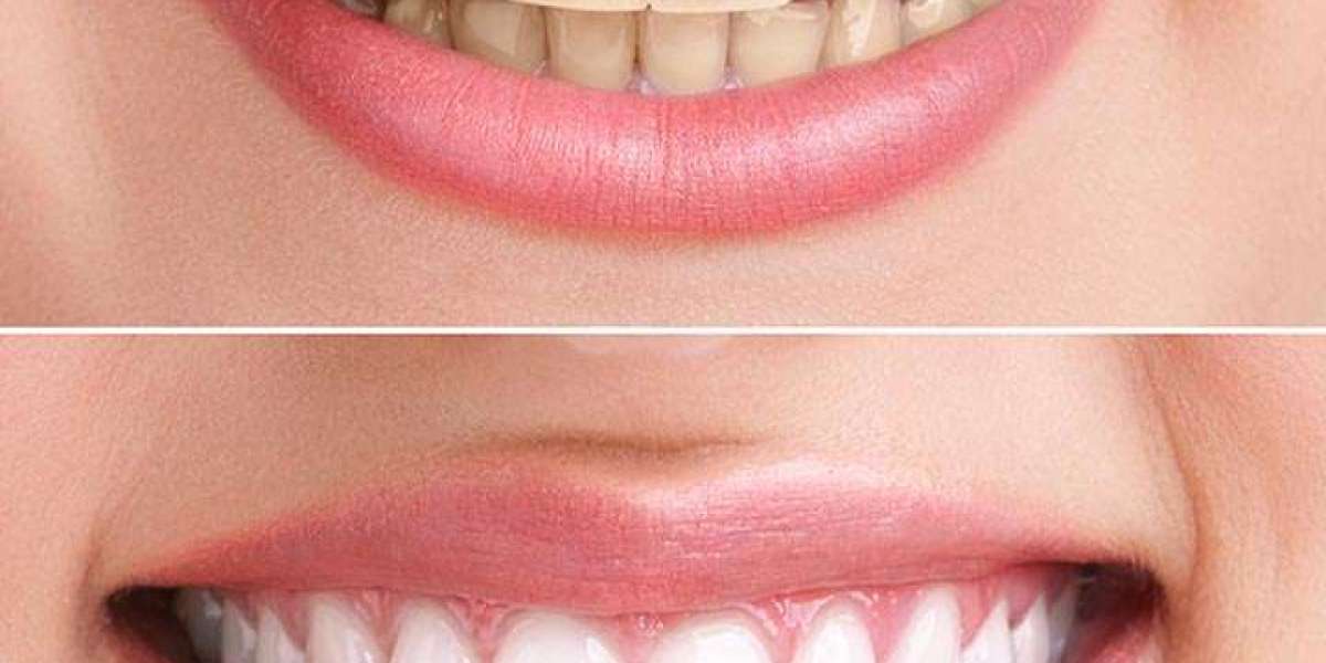 Bright Beyond Belief: Hydrogen Peroxide Whitening Solutions Explored