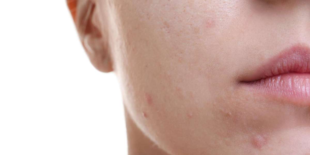 Unlock Clear Skin: Top Acne Scar Treatments in Dubai