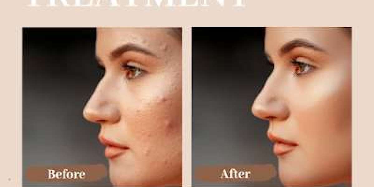 Derma 360's Tailored Approach to Acne Treatment in KPHB