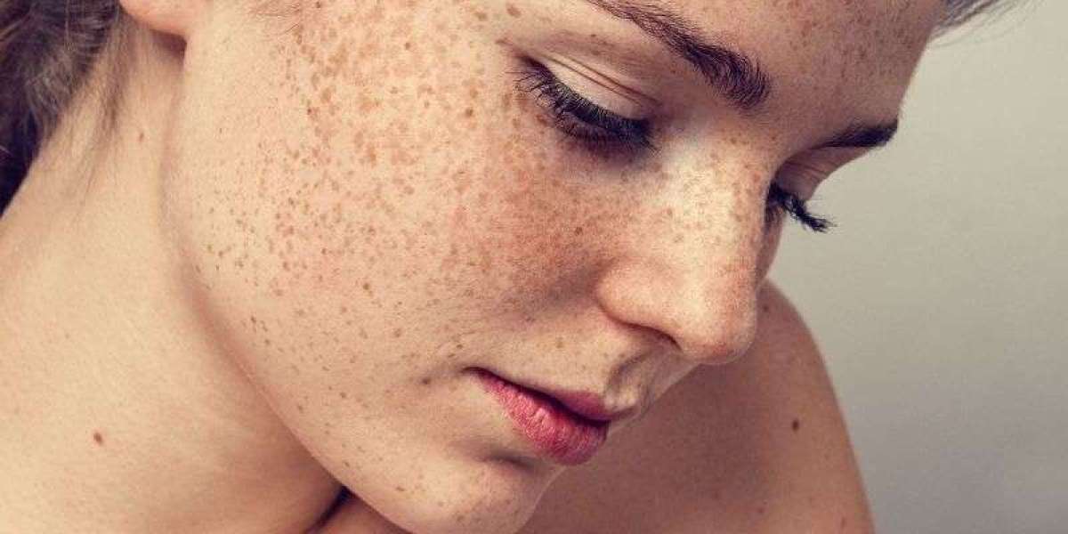 Freckled and Fearless: The Road to Unapologetic Beauty
