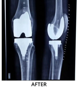 What is Total Knee Replacement? – Dr Sumit Badhwar