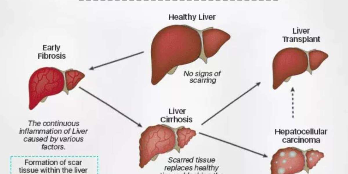 Revolutionizing Liver Cancer Treatment: Dendritic Cell Therapy and Unraveling its Impact on Different Types of Liver Can