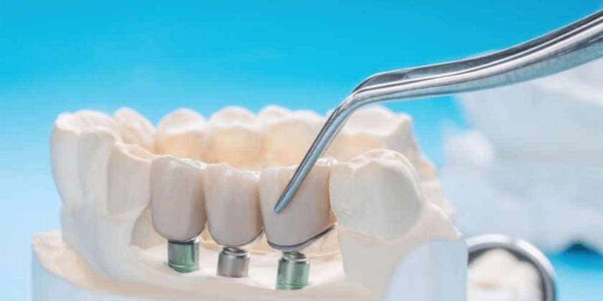 Beyond Gaps: Aesthetic Dentistry and the Beauty of Cosmetic Bridges