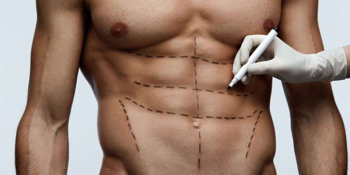 Precision Body Sculpting: The Liposuction Advantage