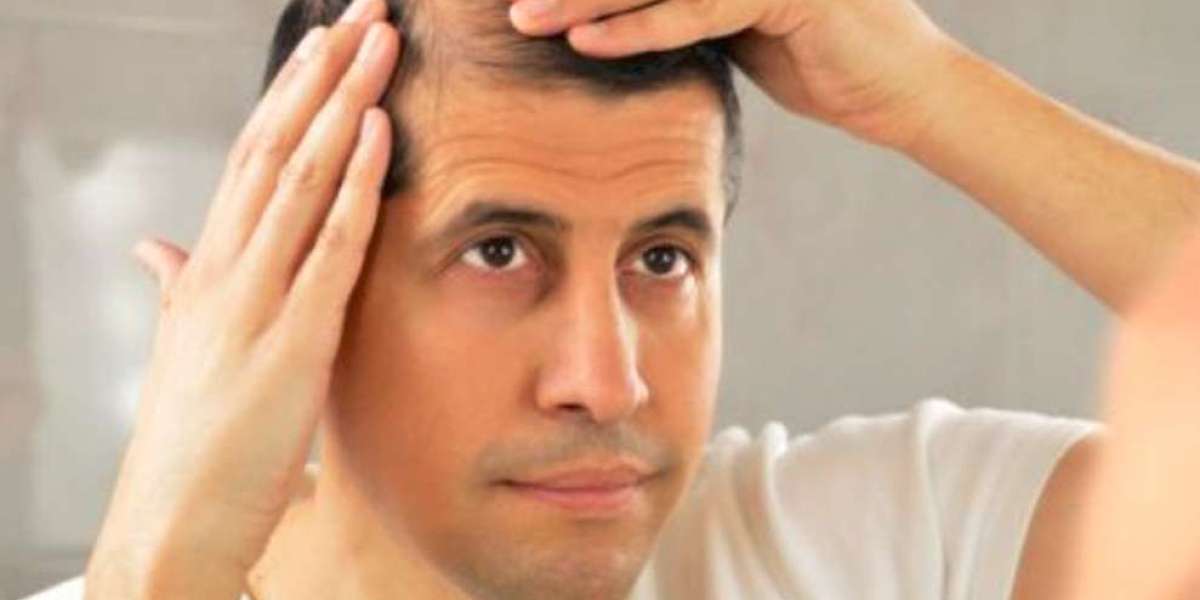 Beyond Baldness: A Comprehensive Guide to Hair Transplants