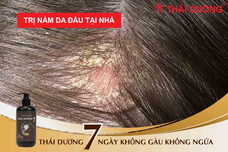 17+ cách trị nấm da đầu tại nhà đơn giản hiệu quả KHÔNG NÊN bỏ lỡ!