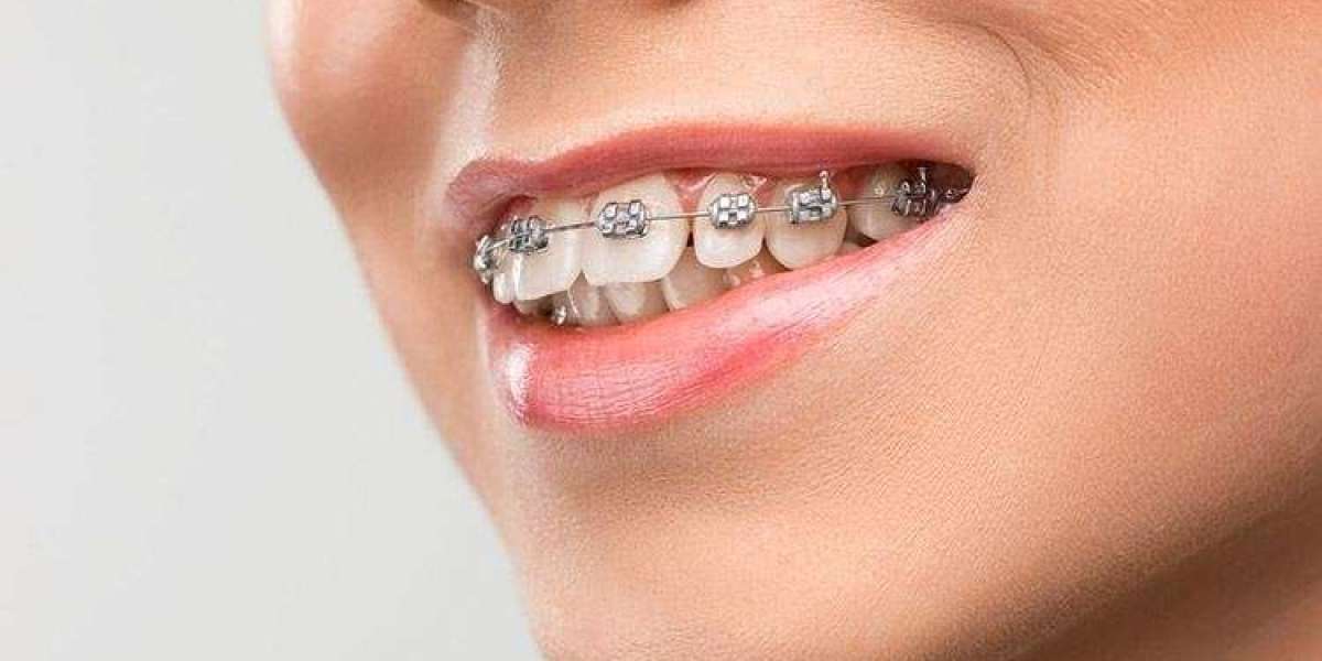Orthodontic Marvels: Prominent Teeth Transformation Stories