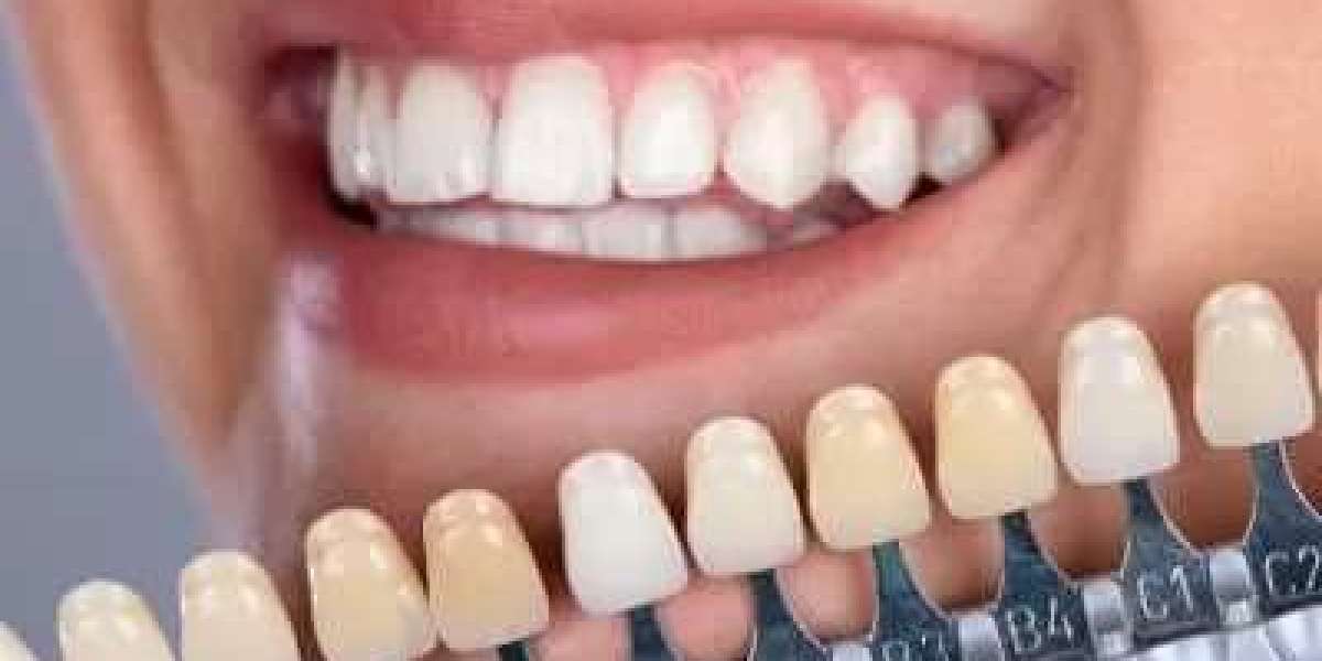 How to Choose the Right Dentist for Dental Veneers in Dubai