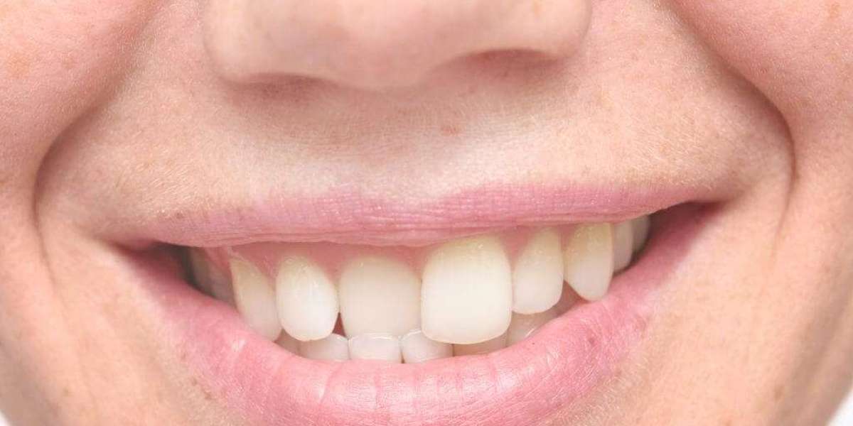 Orthodontic Marvels: Navigating Crowded Teeth with Ease