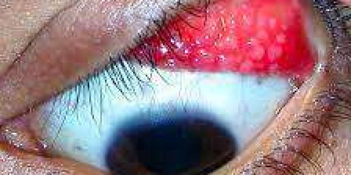 Global Giant Papillary Conjunctivitis Market Size, Share, Trend and Forecast 2021-2030