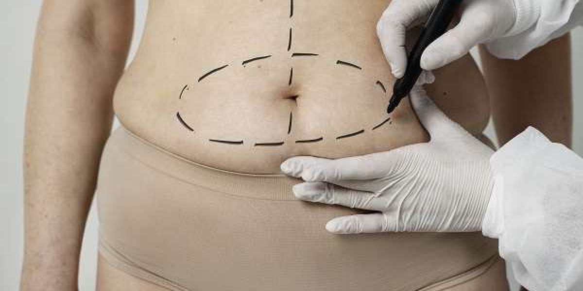 Precision and Perfection: The Dubai Experience of Liposuction