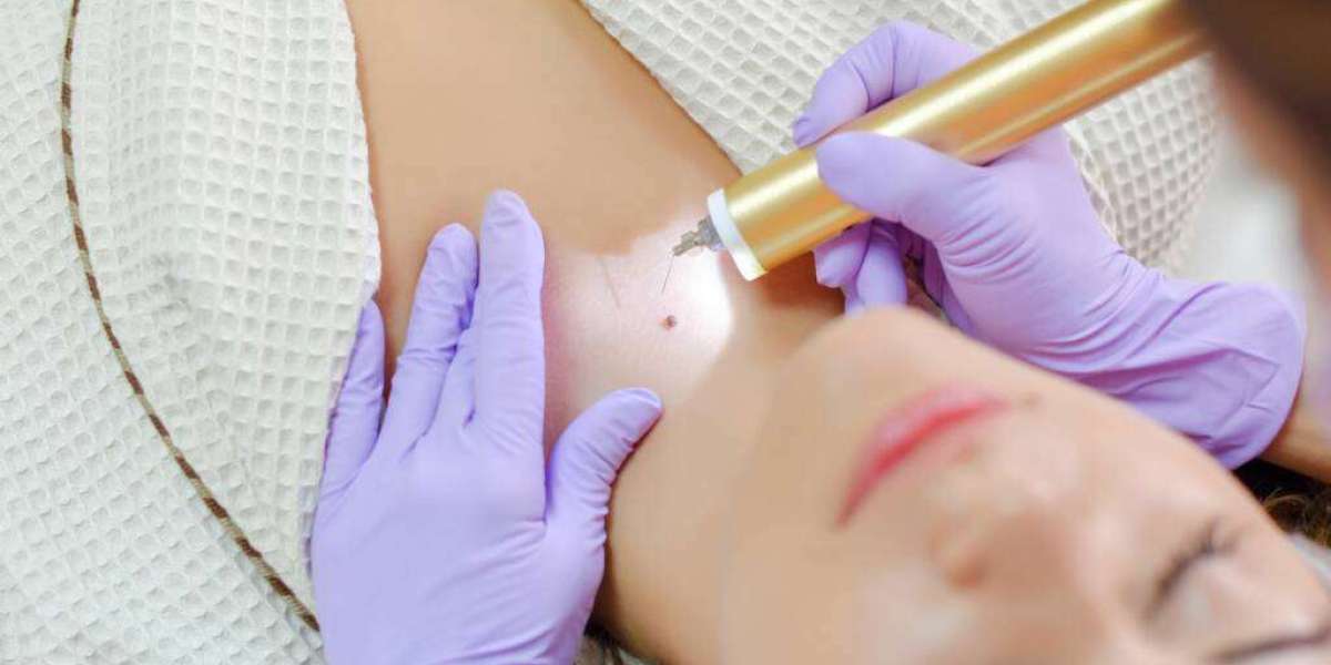 "Topical Treatments: A Quick Fix for Annoying Skin Tags"