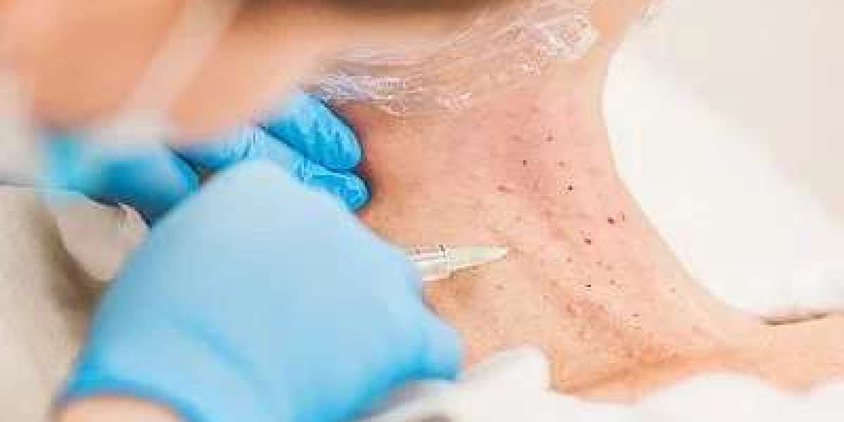Smooth Sailing: Botox for a Youthful Neck - Navigating the Waters of Neck Rejuvenation
