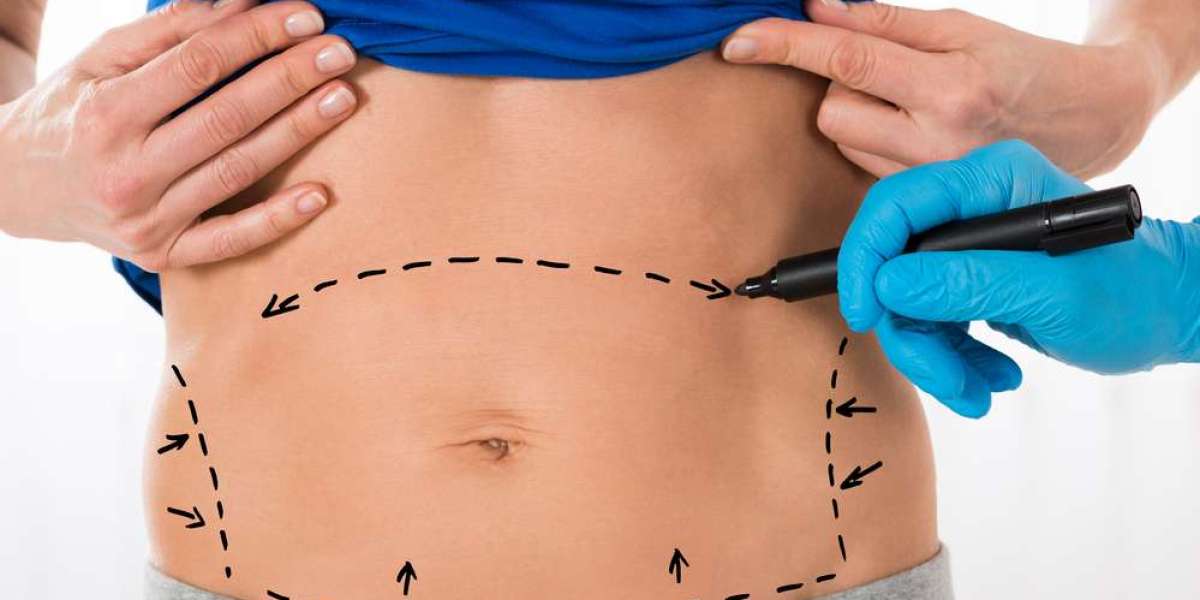 Abs of Steel: How to Sustain Your Tummy Tuck Transformation
