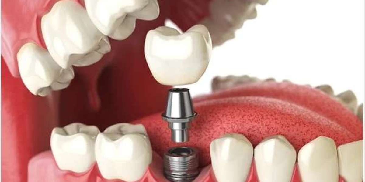 Complete Your Grin: Dental Implants Services