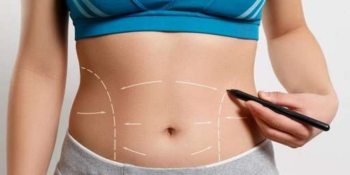 Embracing the New Era of Tummy Tuck Marvels