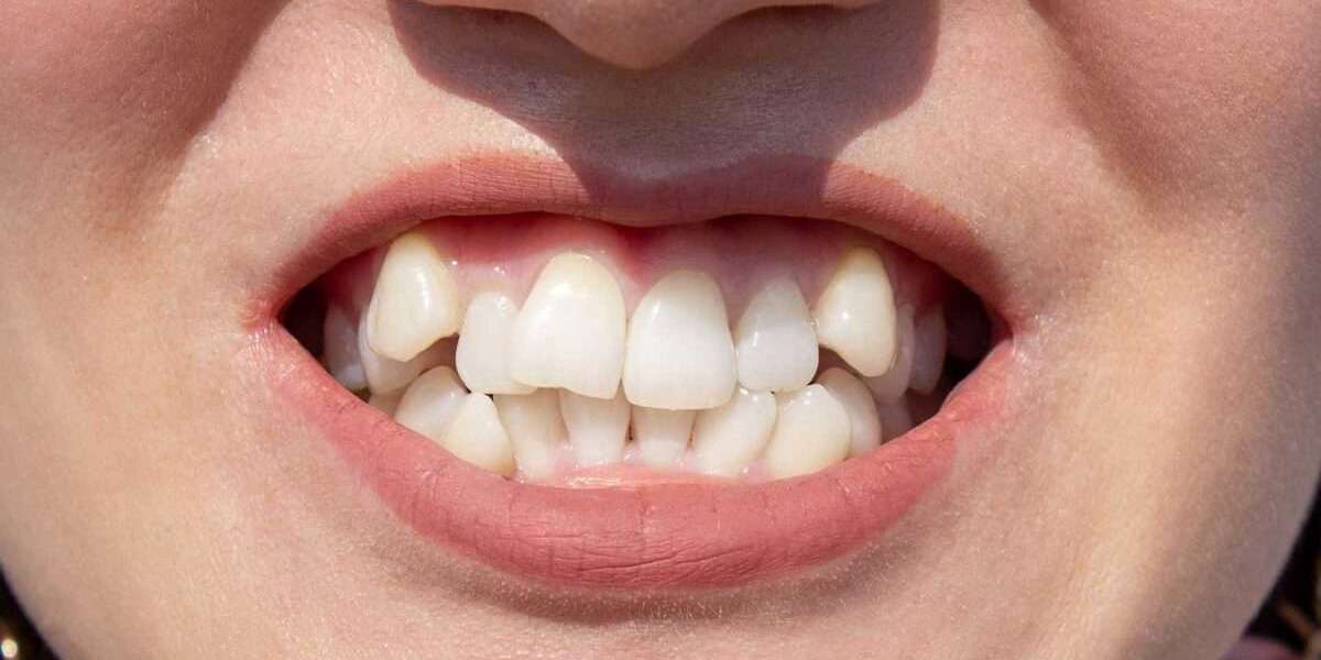 Radiant Alignment: The Pursuit of Overlap-Free Teeth