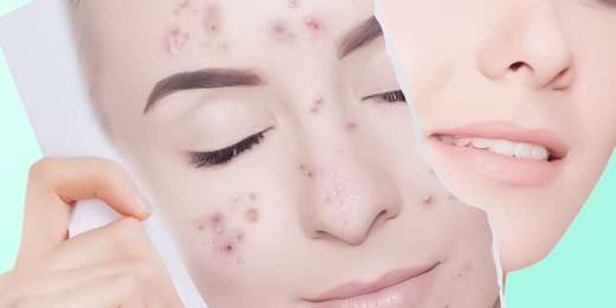 "The Beauty Beneath Superficial Chemical Peels for Skin Renewal"