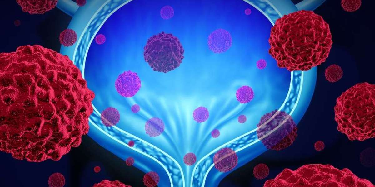 Urothelial Cancer Treatment Market Analysis and Research Report [2031]